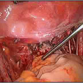 Bilateral Pelvic Lymphadenectomy
