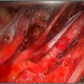 Close-up of Right pelvic dissection