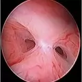 Hysteroscopic Surgery