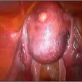 Hysteroscopic Surgery