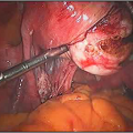 Hysteroscopic Surgery