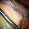 Solid Ovarian Tumour