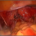 Hysteroscopic Surgery