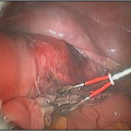 Hysteroscopic Surgery