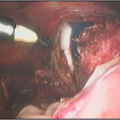Hysteroscopic Surgery