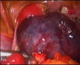 Salpingo-oophorectomy for twisted Ovarian cyst