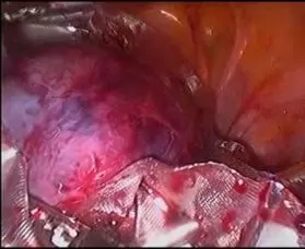 Cyst placed in an Endobag prior to retrieval