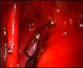 Suture-ligation and Clipping of Uterine Artery at origin at TLH
